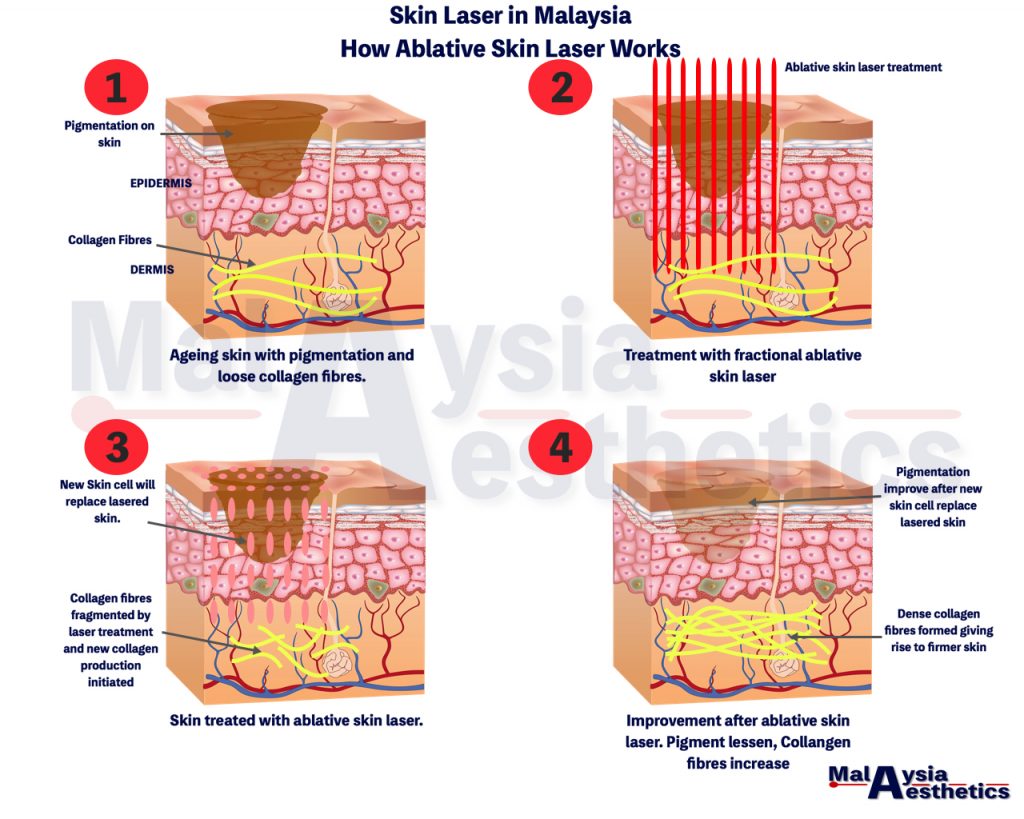 Skin Laser Malaysia, Pigmentation Laser in Malaysia - Malaysia Aesthetic