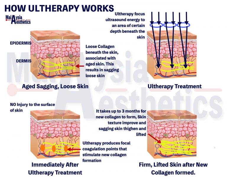 Ultherapy Malaysia | Ultherapy Review | HIFU - Malaysia Aesthetic