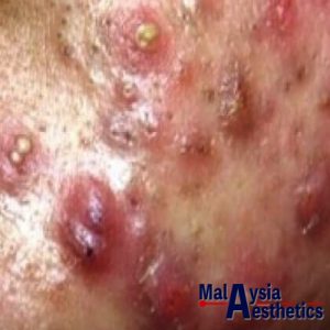 Nodular Cystic Acne